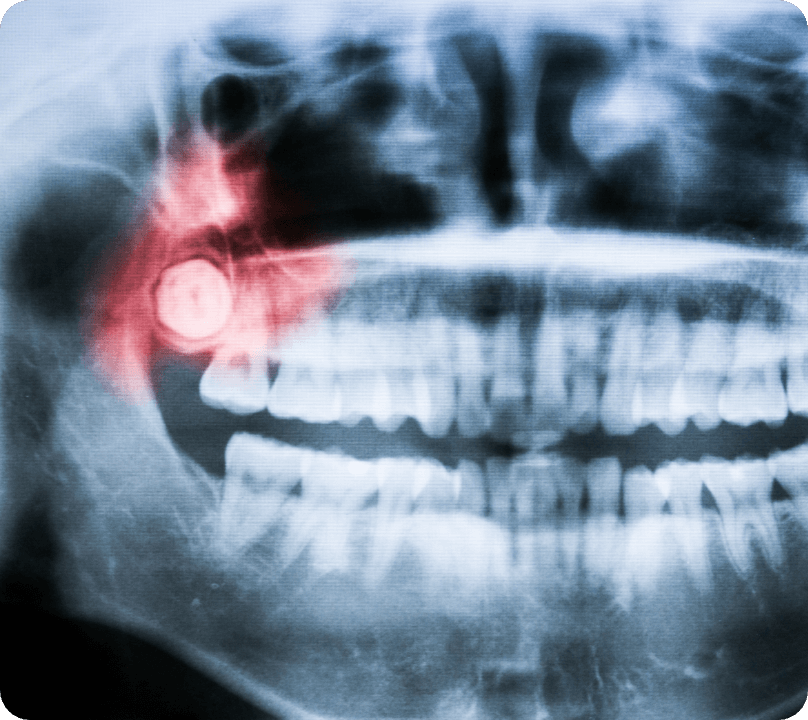 レントゲンで見た親知らず