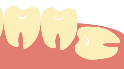 イラスト：親知らずが埋まっている
