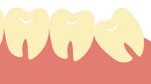 イラスト：親知らずが横向きに生えている