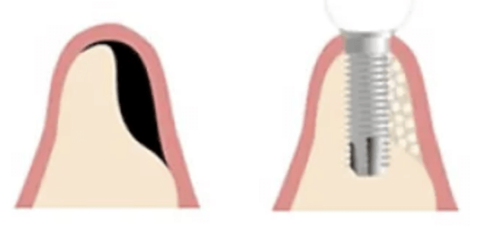骨誘導再生法（GBR法）