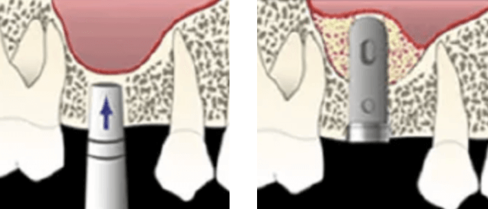 ソケットリフト法（上顎洞挙上術）