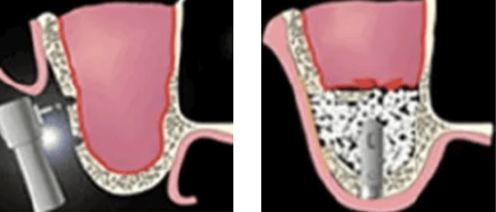 サイナスリフト法（上顎洞挙上術）